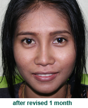 plastic_surgery_augmentation_rhinoplasty